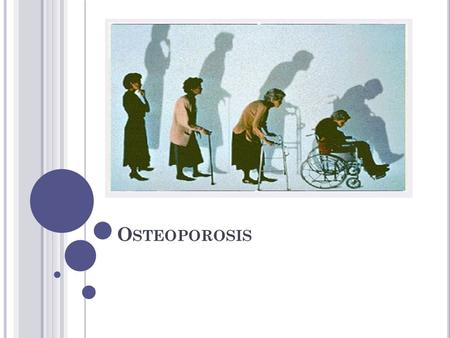 Osteoporosis.