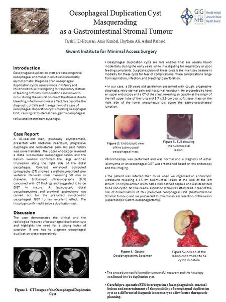 Introduction Oesophageal duplication cysts are rare congenital oesophageal anomalies in adults and are mostly asymptomatic. Diagnosis of an oesophageal.