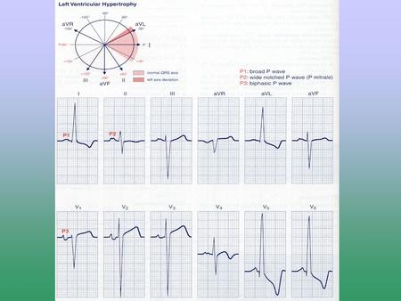 Pericarditis Is an inflammatory disease of the pericardium, directly involving the epicardium. Deposits of inflammatory cells and variable amounts of.