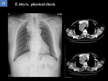 F, 66y/o, physical check 11. Ans : Intrathoracic goiter.