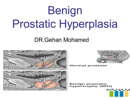 Benign Prostatic Hyperplasia