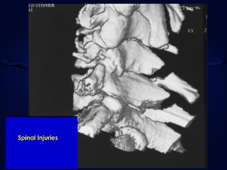 Why do spinal injured patients die? Diagnostic dilemmas Management errors Misunderstanding spinal cord injuries Why do things go wrong ? Long term problems.