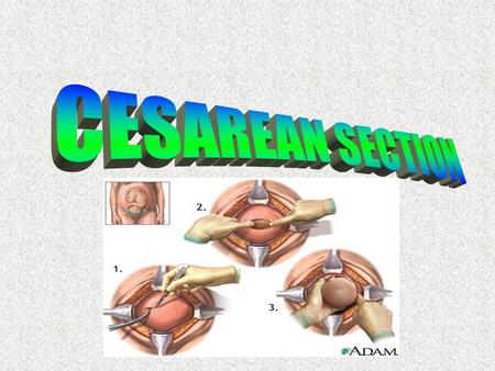 Cesarean section (CS) Caesarean section or c-section, is a delivary of the foetus through incisions in anterior abdominal (laparotomy) and uterine wall.