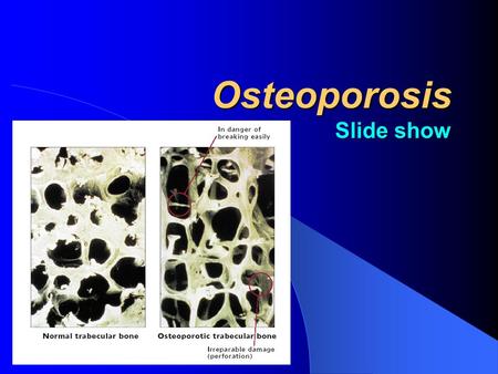 Osteoporosis Slide show