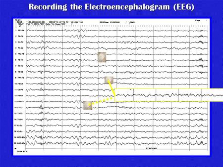 Recording the Electroencephalogram (EEG). Recording the EEG.