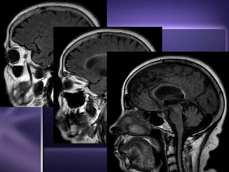 Sagittal FLAIR images - Stable nonenhancing hyperintensities within the pericallosal white matter and bilateral centrum semiovale, consistent with known.