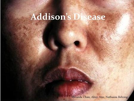 Addison’s Disease Miranda Chan, Aliny Ater, Nathania Rebong.