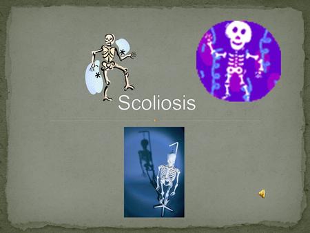 Scoliosis is a condition also known as “curvature of the spine”. People with scoliosis have curves in their spine that are bigger than the regular curves.