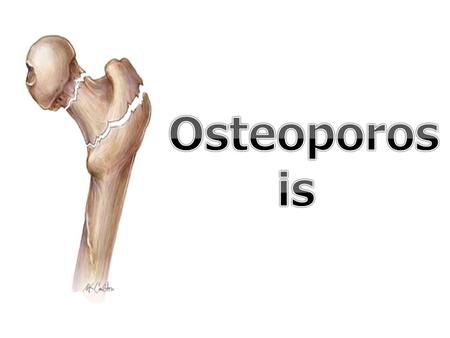 WHAT IS Osteoporosis ? Osteoporosis is a common disease in the whole world, the danger in that disease is that you can't figure out if you have it early,