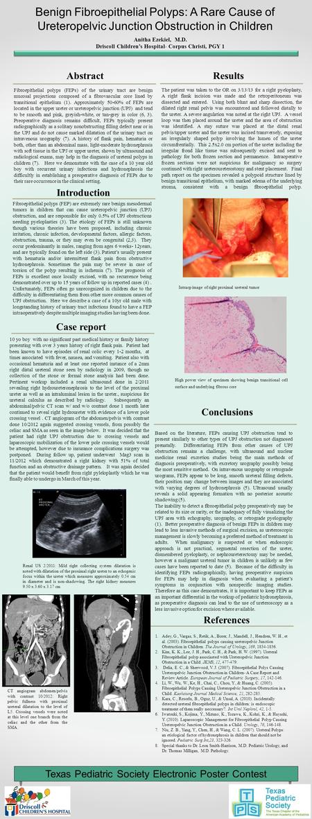 Abstract Fibroepithelial polyps (FEPs) of the urinary tract are benign mucosal projections composed of a fibrovascular core lined by transitional epithelium.