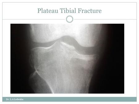 Plateau Tibial Fracture Dr. L.A Ledwaba. Epidemiology Common young male elderly females Dr. L.A Ledwaba.