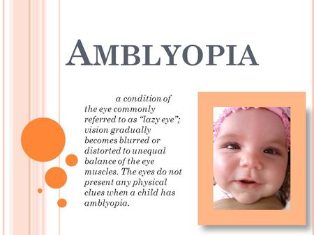 Amblyopia a condition of the eye commonly referred to as “lazy eye”; vision gradually becomes blurred or distorted to unequal balance of the eye muscles.