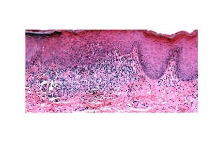 Hairy leukoplakia Distinctive oral lesion Seen in immunocompromised patients 80% of patients with hairy leukoplakia have HIV infection.