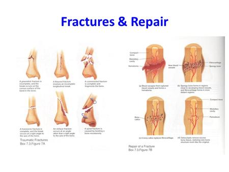 Fractures & Repair. Male vs. Female Pelvis Female Structure (All related to female pelvis functioning as a birth canal): Iliac bones more flared Angle.