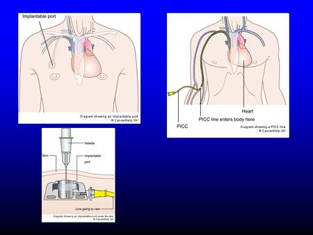 HICKMAN CATHETER Thrombotic complications associated with venous access devic Thrombotic complications associated with venous access devices Occlusion.