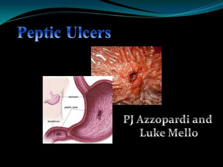 A sore in the lining in the ach or duodenum. Most commonly caused by infection with the bacterium h. pylori What is an ulcer? Sharp abdominal pains, bloating,