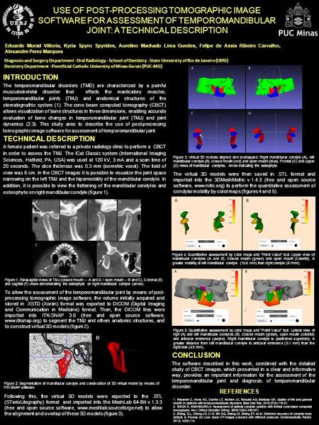 REFERENCES INTRODUCTION The temporomandibular disorders (TMD) are characterized by a painful musculoskeletal disorder that effects the masticatory muscles,