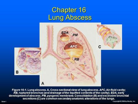 Copyright © 2006 by Mosby, Inc. Slide 1 Chapter 16 Lung Abscess Figure 16-1. Lung abscess. A, Cross-sectional view of lung abscess. AFC, Air-fluid cavity;