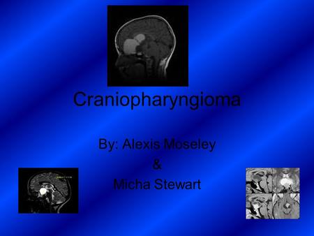 Craniopharyngioma By: Alexis Moseley & Micha Stewart.