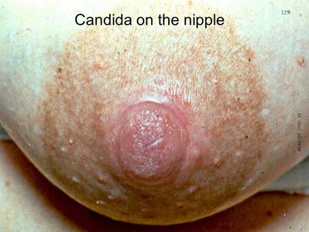 Candida on the nipple 12/9 ©UNICEF C