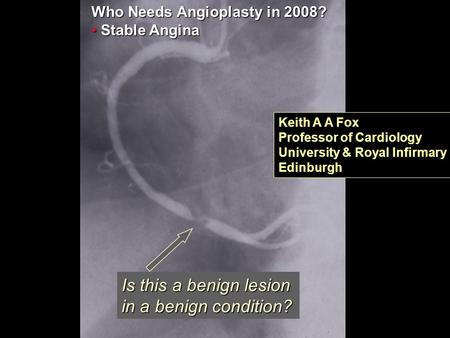 RITA-3 Is this a benign lesion in a benign condition? Who Needs Angioplasty in 2008? Stable Angina Stable Angina Keith A A Fox Professor of Cardiology.