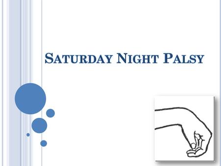 Saturday Night Palsy.