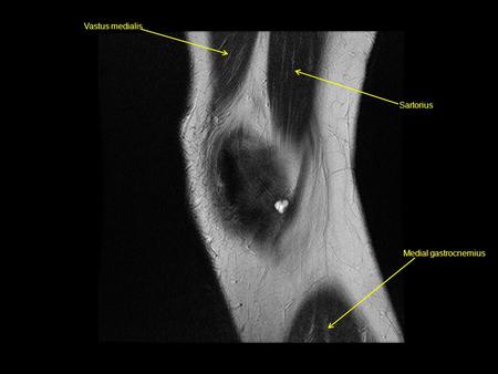 Vastus medialis Medial gastrocnemius Sartorius.