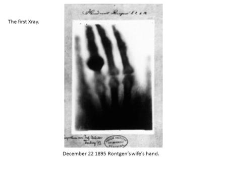 December 22 1895 Rontgen’s wife’s hand. The first Xray.