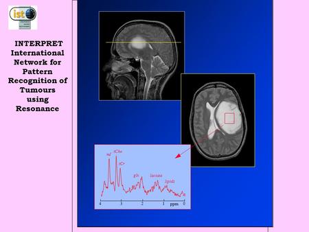 Lactate glx tCr tCho mI 01234 ppm lipids INTERPRET International Network for Pattern Recognition of Tumours using Resonance lactate glx tCr tCho mI 01234.