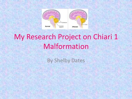 My Research Project on Chiari 1 Malformation By Shelby Dates.