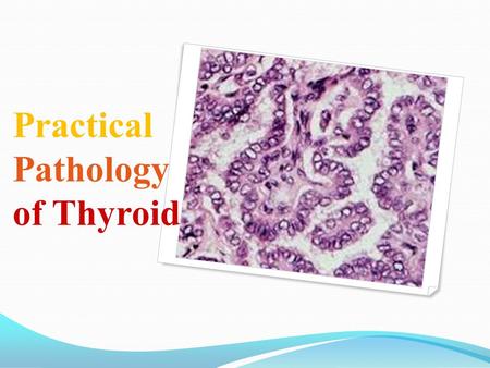 Practical Pathology of Thyroid. Case 1 A 50 yr old lady presents with a mass in anterior neck Slowly growing since 10 yr ago Soft and nodular, moves with.