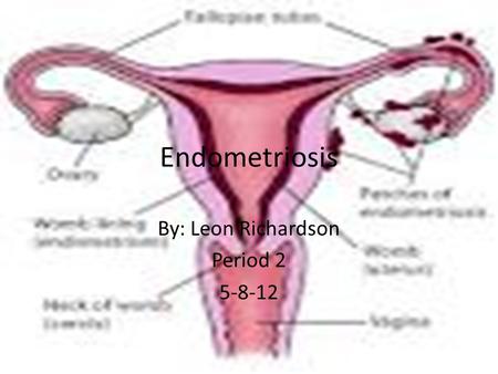 Endometriosis By: Leon Richardson Period 2 5-8-12.