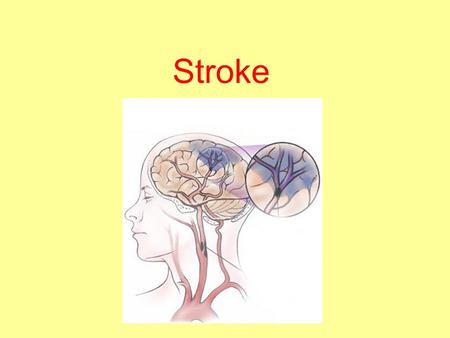 Stroke. Definition Cerebrovascular accident (CVA) The rapidly developing loss of brain functions due to disturbance in the blood supply to the brain.