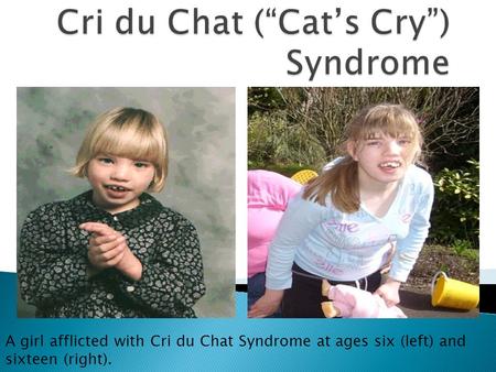 A girl afflicted with Cri du Chat Syndrome at ages six (left) and sixteen (right).