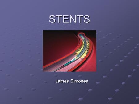 STENTS James Simones. History Balloon Angioplasty introduced in the late 70’s Approximately 30% would close up after Some so severe that the artery would.