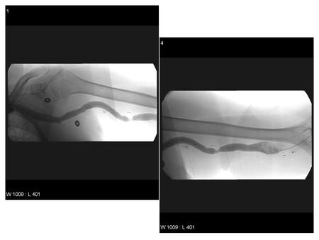 Findings/Discussion AV fistula with outflow stenosis far from anastomosis Stenosis typically due to fibrotic, hyperplastic or elastic lesions. –Increased.