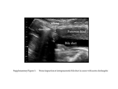 Bile duct Pancreas head duodenum stone Supplementary Figure 1: Stone impaction at intrapancreatic bile duct in cases with acute cholangitis.