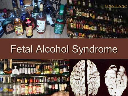 Fetal Alcohol Syndrome Michael Hoerger. Epistemology  Case studies  Epidemiology  Randomized Controlled Trials (RCTs)  Teratogens: Thalidomide tragedy.