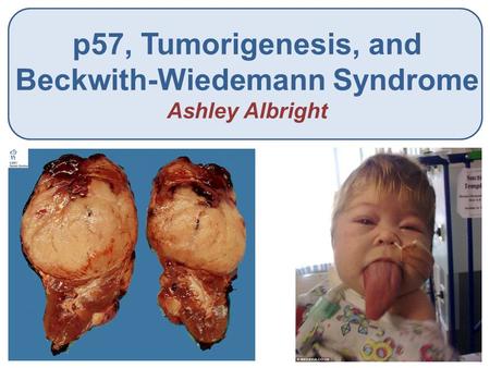 P57, Tumorigenesis, and Beckwith-Wiedemann Syndrome Ashley Albright.