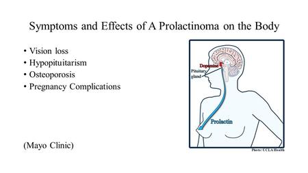 Symptoms and Effects of A Prolactinoma on the Body Vision loss Hypopituitarism Osteoporosis Pregnancy Complications (Mayo Clinic) Photo: UCLA Health.