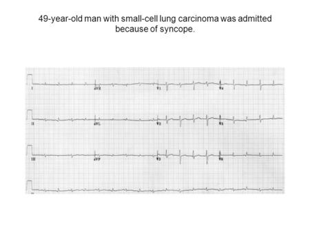 49-year-old man with small-cell lung carcinoma was admitted because of syncope.