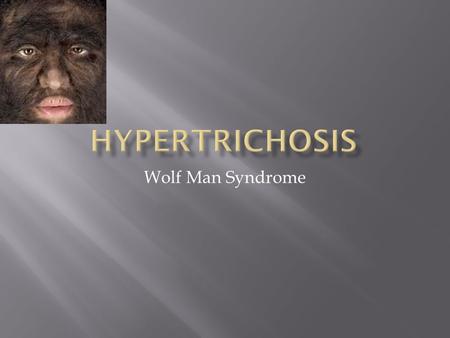 Wolf Man Syndrome  Hypertrichosis (Ambras Syndrome) is a genetic disorder that causes large amounts of hair to grow all over the body or in one spot.