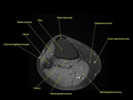 Tibial tuberosity Saphenous nerve Great saphenous vein