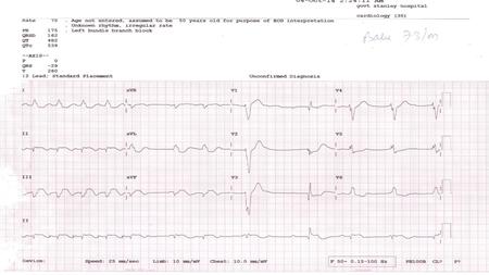 Alternating bundle branch block  Alternating bundle branch block is diagnosed when conducted periods of RBBB and LBBB were noted in a patient on the.