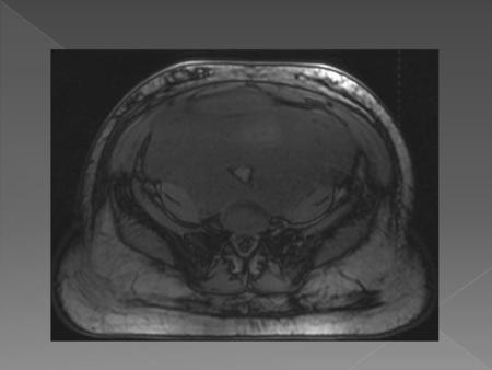  Aggressive Angiomyxoma (AA) is a very rare tumor. It was first described in 1983 and since then only about 250 cases have been reported  Women.