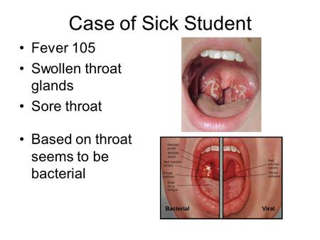 Case of Sick Student Fever 105 Swollen throat glands Sore throat Based on throat seems to be bacterial.