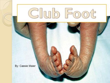 By: Cassie Maier. What is Club Foot? Club Foot is when one or both babies feet are turned inward and downward and cannot be put into normal position easily.