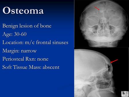 Osteoma Benign lesion of bone Age: 30-60 Location: m/c frontal sinuses Margin: narrow Periosteal Rxn: none Soft Tissue Mass: abscent.