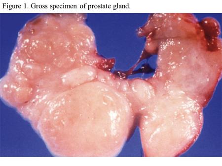 Figure 1. Gross specimen of prostate gland.. Figure 2. Microscopic effects of BPH.