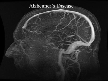 Alzheimer’s Disease. 5.3 Million Progressive Degenerative.